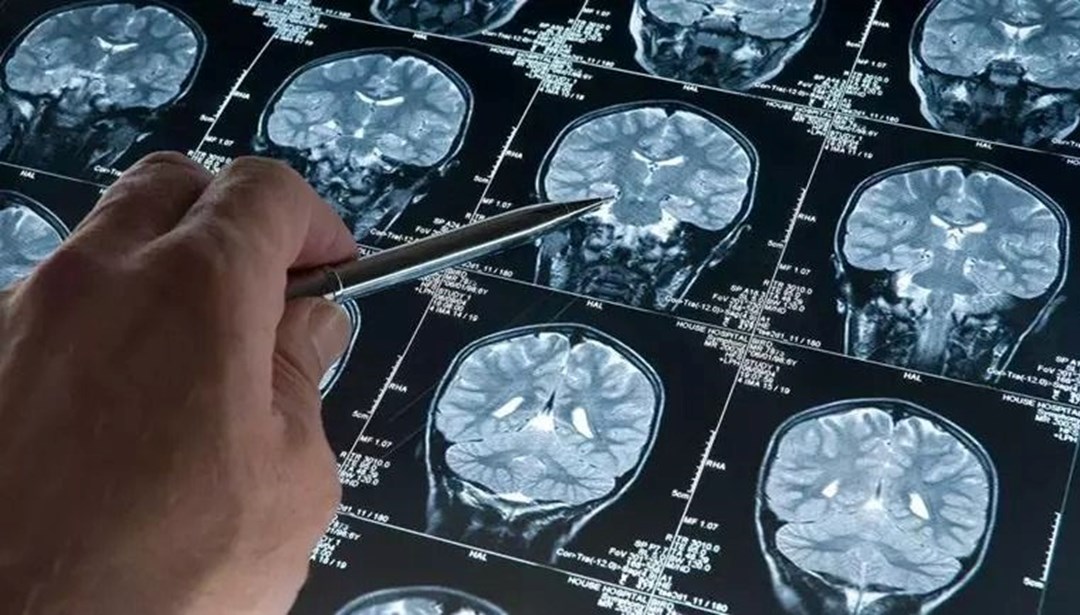 Uyku ilacı ve Alzheimer: Proteinlerin birikimini azaltabilir