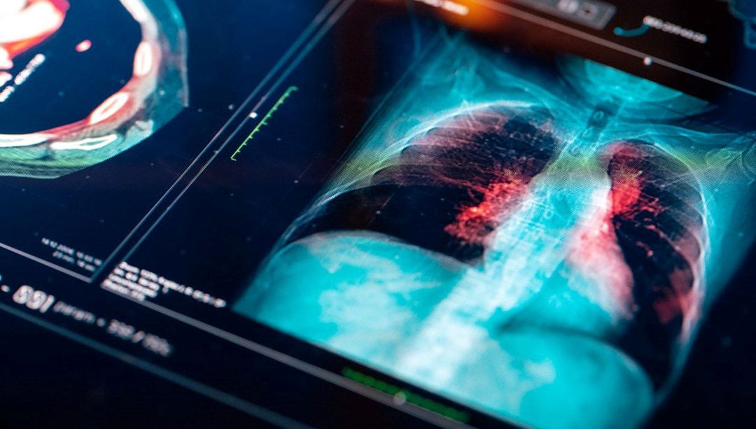 Akciğer kanseri riski taşıyor musunuz? Erken teşhis için önemli