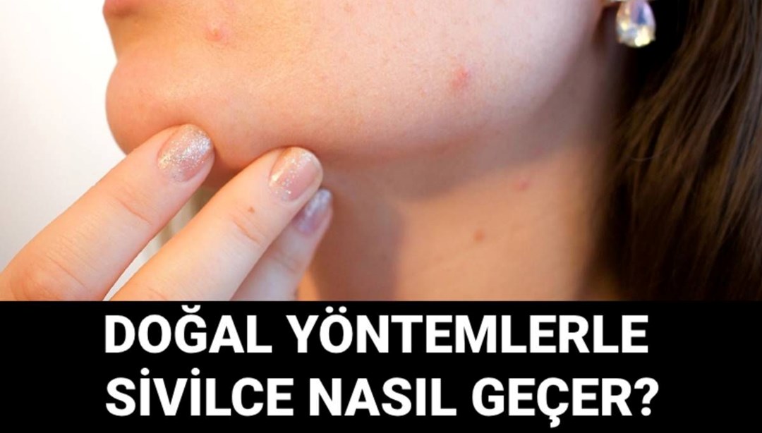 Doğal yöntemlerle sivilce nasıl geçer? Sivilceyi geçiren yöntemler