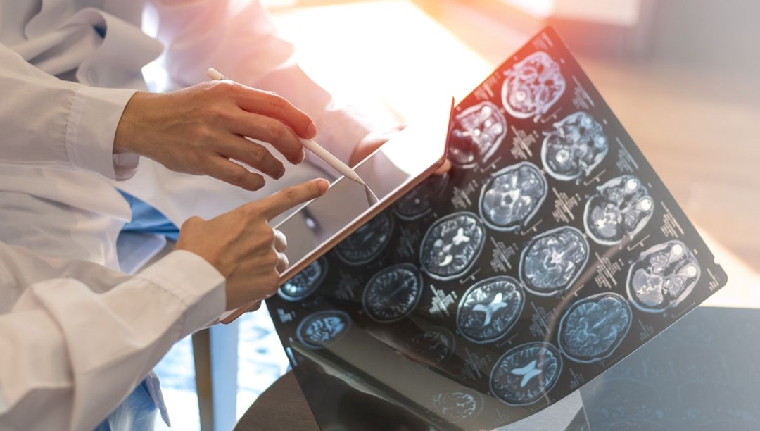 Nöroloji Uzmanı uyarıyor: Ağır Covid-19 geçirenler risk altında – Son Dakika Türkiye Haberleri