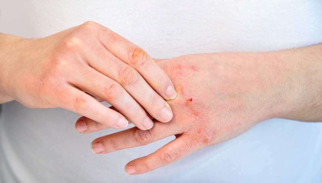 6 belirtiyi yaşıyorsanız dikkat: Yeterli protein tüketmediğinizi gösteriyor