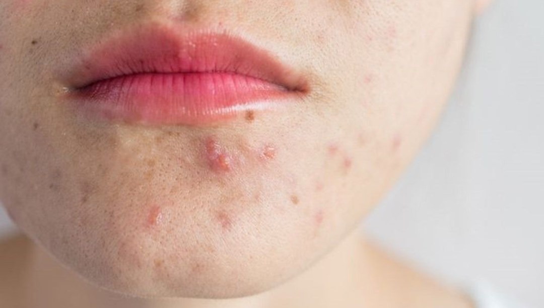 Sivilceye karşı aşı yolda – Sağlık Haberleri