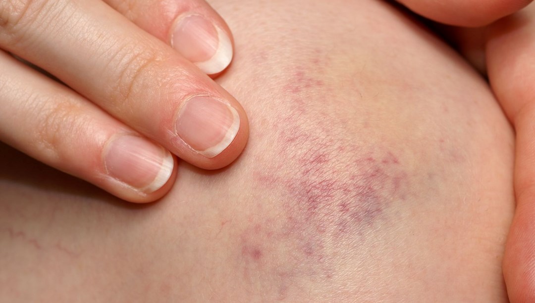 Uzman doktor 5 gizli işareti açıkladı: Vücudunuzdaki temel vitaminler eksik olabilir