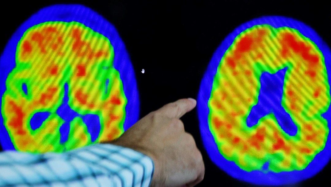 Uçuk ve Alzheimer arasında bağlantı keşfedildi – Son Dakika Dünya Haberleri