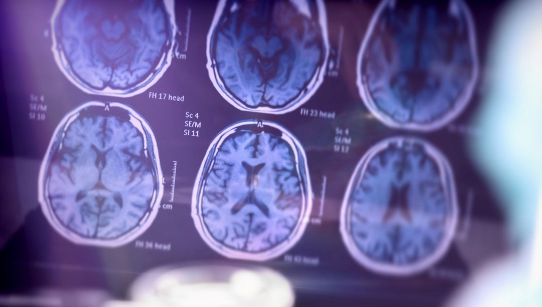 Alzheimer, ölümcül hastalık olmaktan çıkıyor