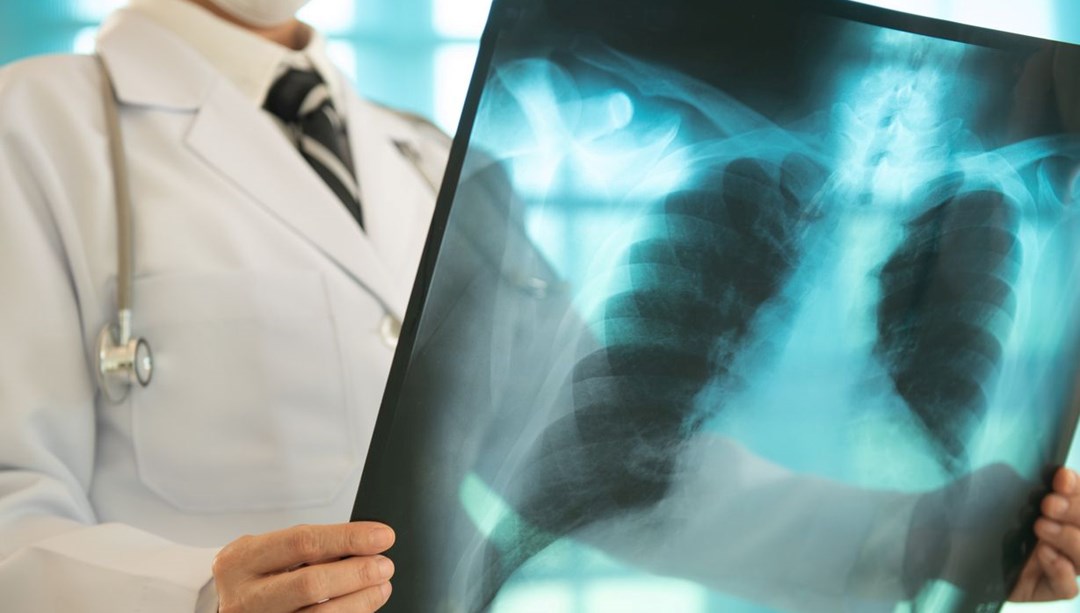 Sigara içmeyenlerde neden Akciğer kanseri görülüyor: 5 nedeni var – Son Dakika Yaşam Haberleri