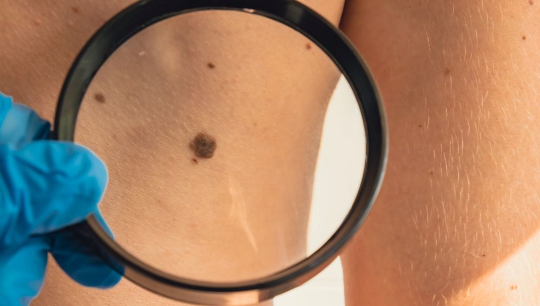 Az bilinen 5 cilt kanseri belirtisi: Ben tek uyarı işareti değil