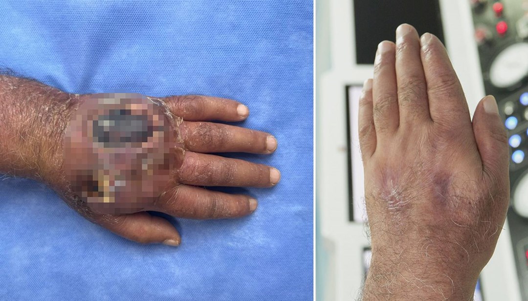 Doktorlar da şaşırdı: Hırsız öyle bir ısırdı ki; literatüre girmeye aday!