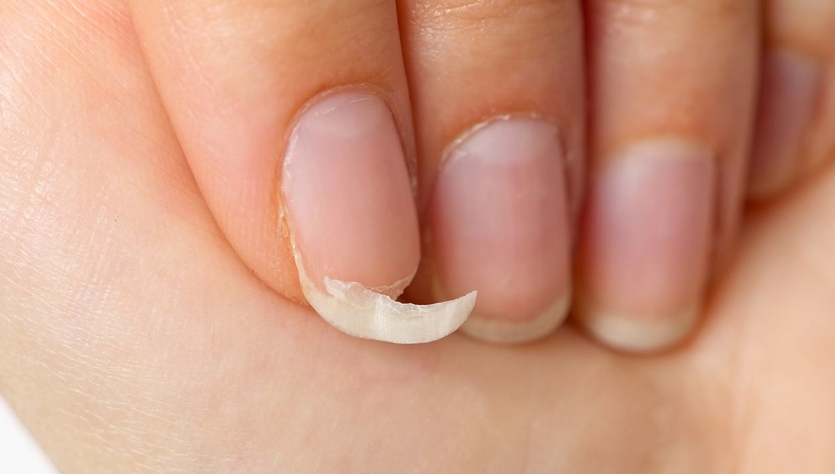 Kırılgan tırnaklar bu 3 hastalığın habercisi: Vücudunuzda eksik olabilir