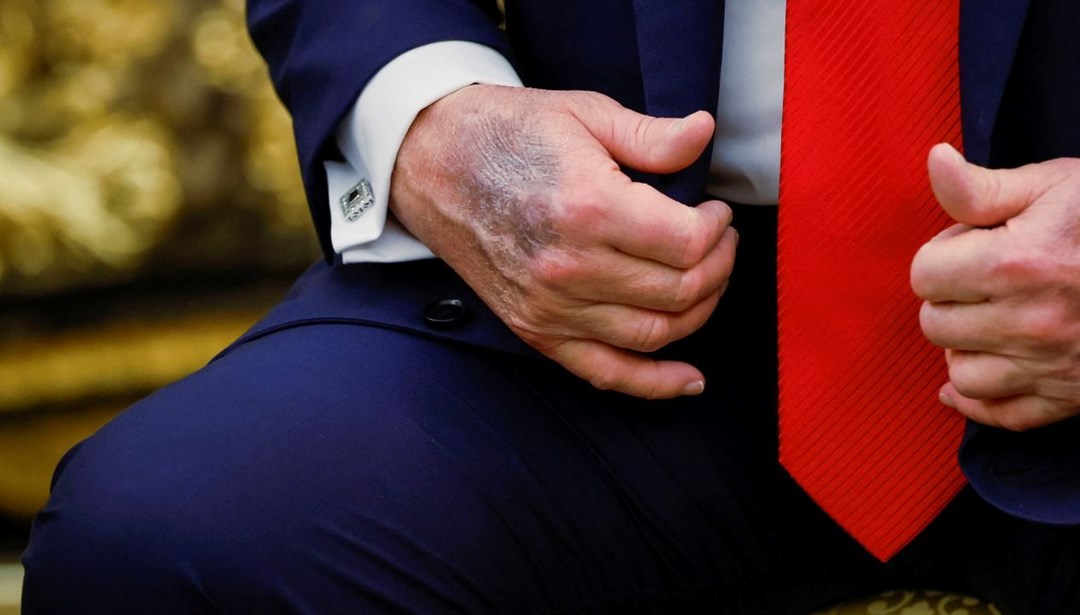 Trump’ın eli yine gündem oldu, Beyaz Saray’dan açıklama geldi – Son Dakika Dünya Haberleri