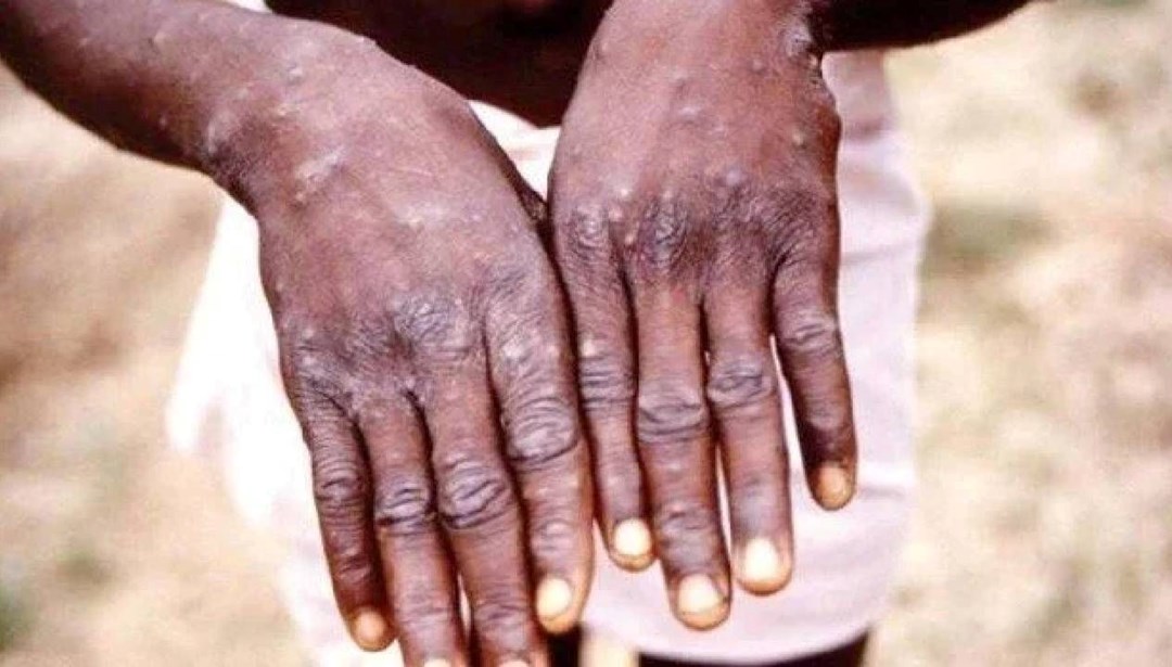 Gana’da M çiçeği vaka sayısı 565’e çıktı