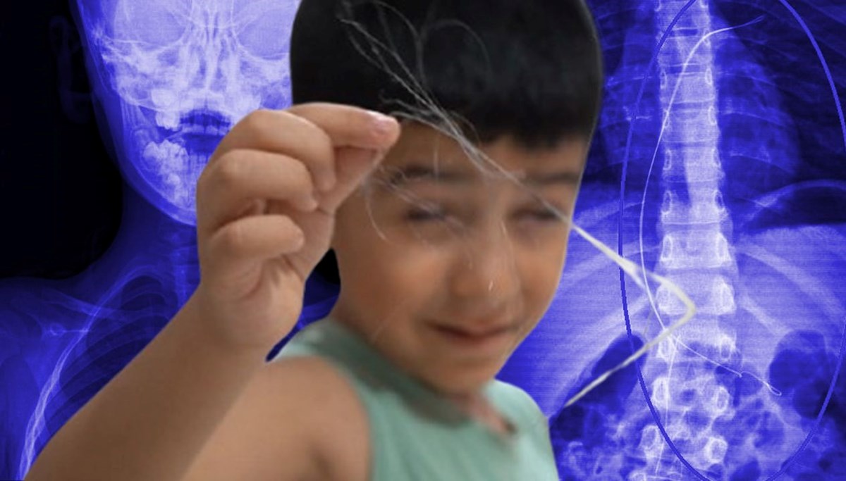 Yuttuğu salatalık akılalmaz gerçeği ortaya çıkardı: 5,5 saatte çıkarıldı, tam 18 santimetre!