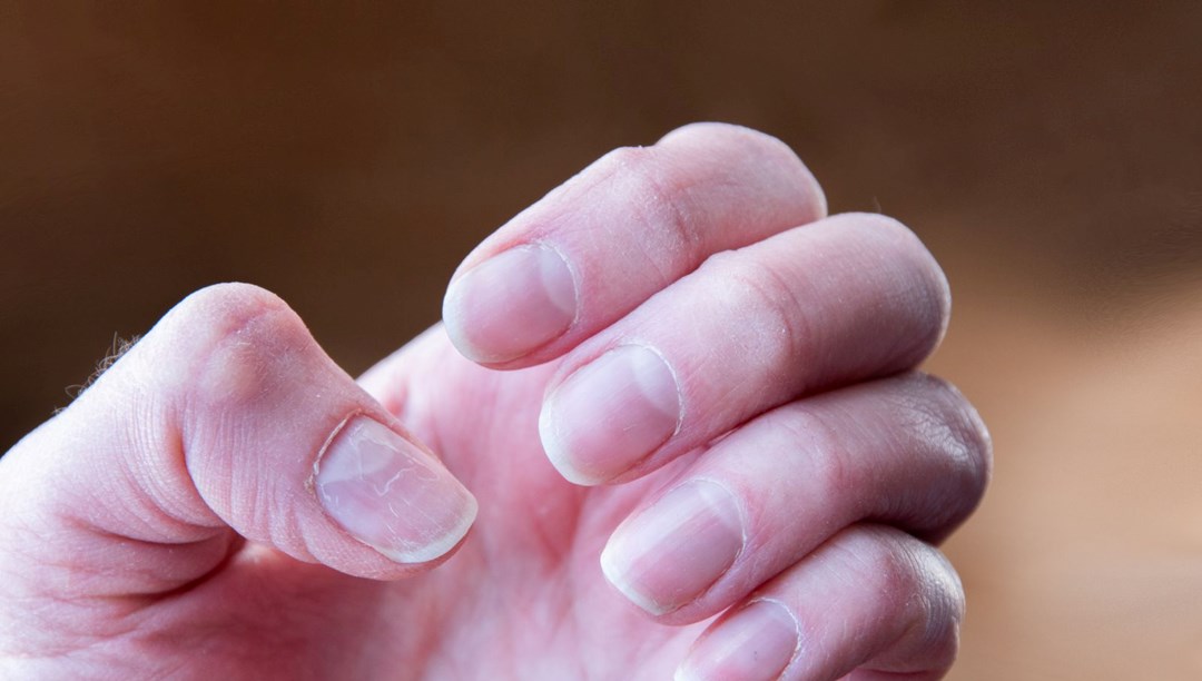 Tırnaklarda ortaya çıkıyor: Görmezden gelinen 6 ciddi işaret