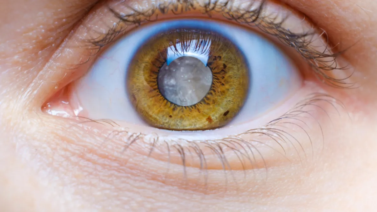 Göz Sağlığınızı Tehdit Eden Glokom: Tehlikeleri ve Belirtileri Neler?