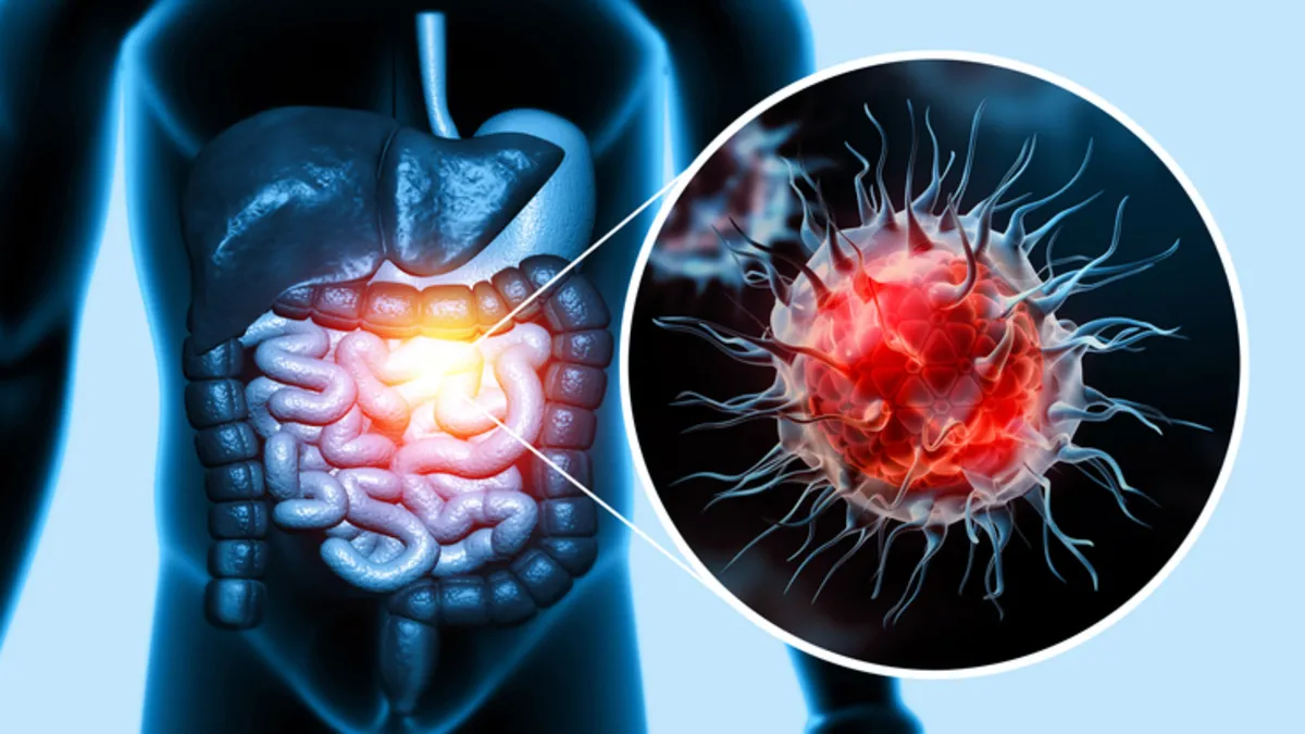 Kolon Kanseri Belirtileri: Dikkat Edilmesi Gereken İşaretler