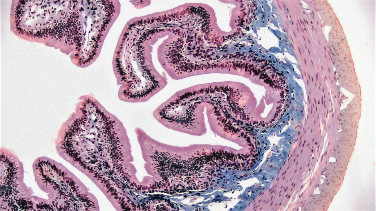 Hedeflenmiş bakteriyofajlar Crohn hastalığına bağlı bağırsak iltihabını azaltıyor