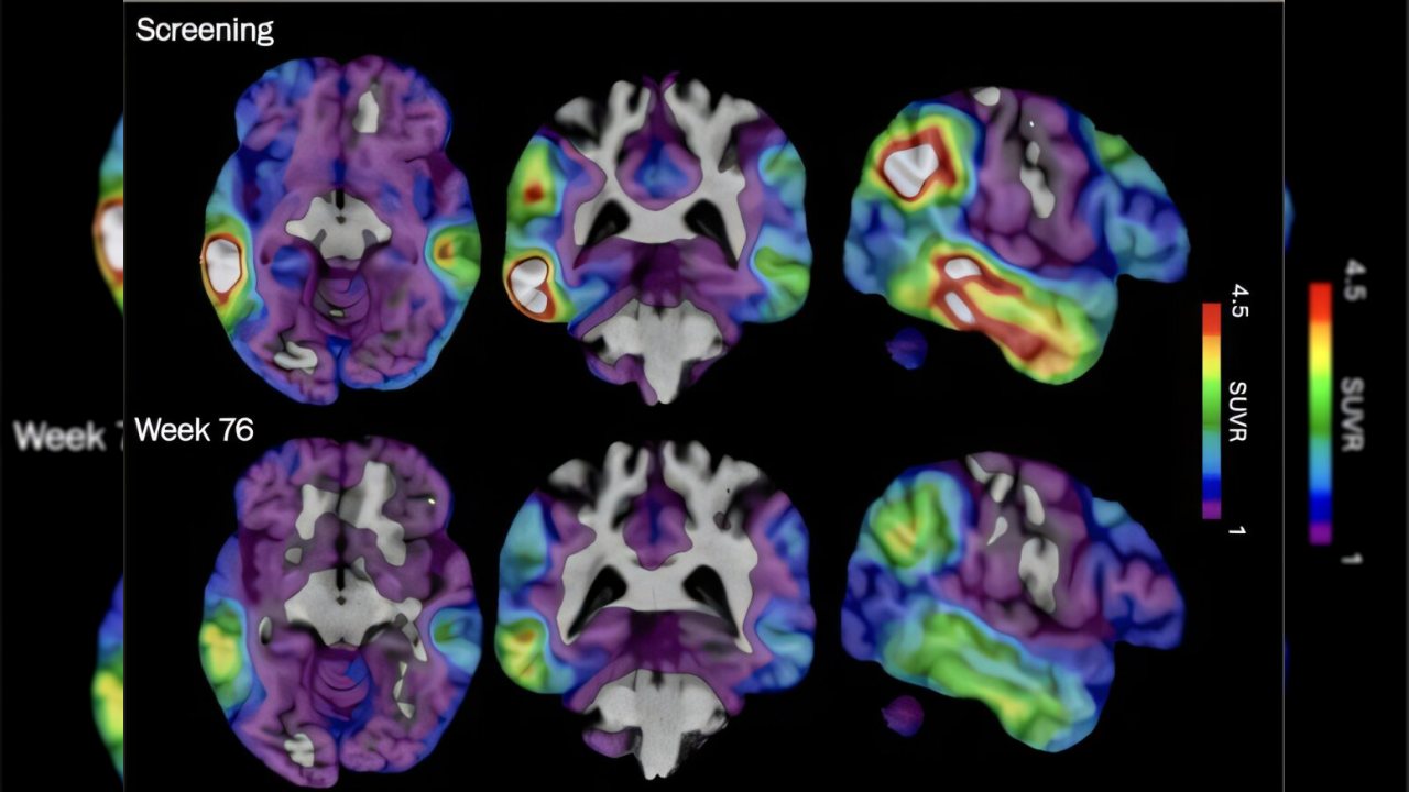Deneysel Alzheimer ilacı, tau proteinini hedef alarak umut veriyor