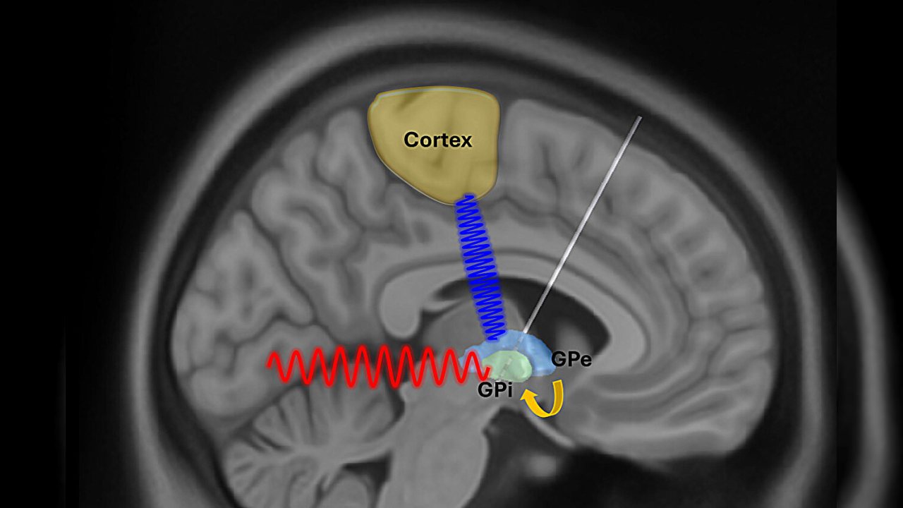 Parkinson Hastalığında Beyin Uyarımına Yeni Bir Yöntem Geliştirildi