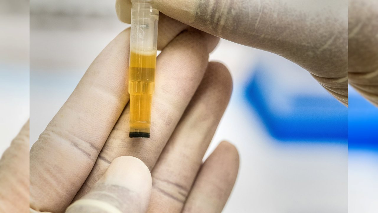 Tip 2 Diyabet Hastalarında Böbrek Koruma Testi Önerisi