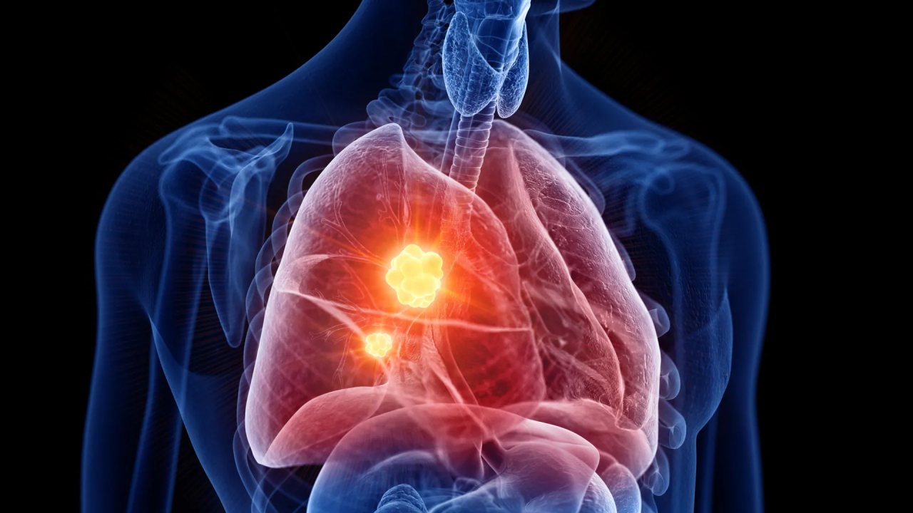 Yeni Mesotelyoma İlaç Denemesi Kanserle Mücadelede Umut Veriyor