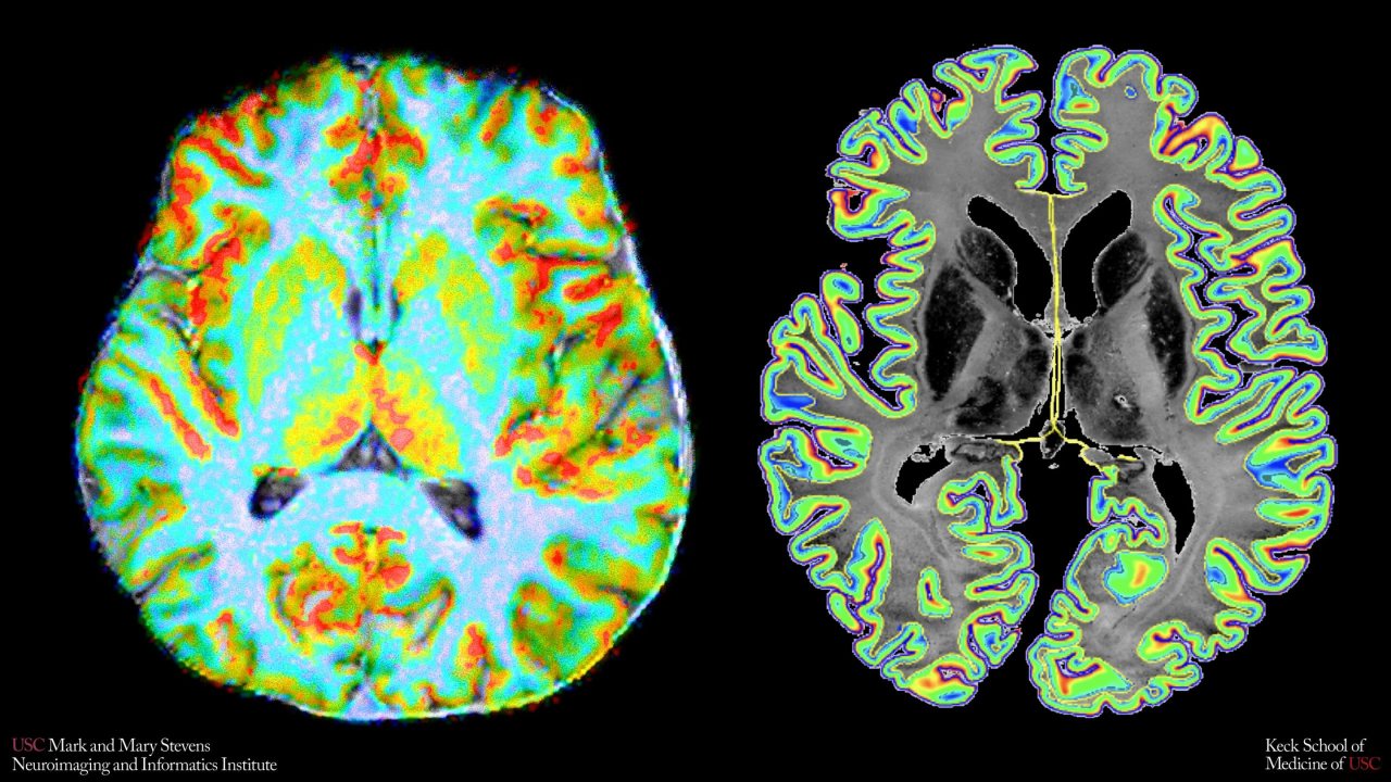 Yeni MRI Yöntemi Beyindeki Kan Akışını İnceliyor