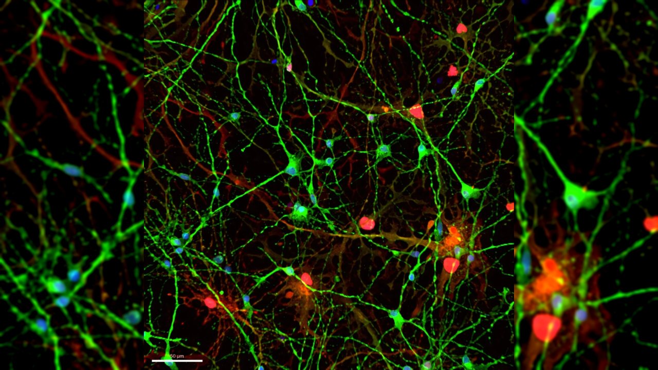 Alzheimer Hastalarında Meprin-β Proteini Artışı Tespit Edildi