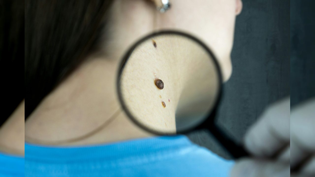 Kişiye Özel Melanoma Aşısı Ölüm Riskini Azaltıyor
